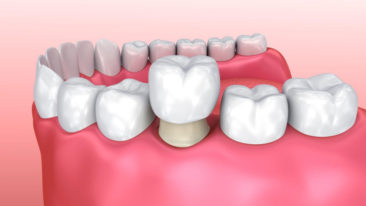 Lifestyle Factors That Extend the Lifespan of Dental Crowns
