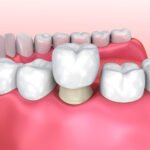 Lifestyle Factors That Extend the Lifespan of Dental Crowns