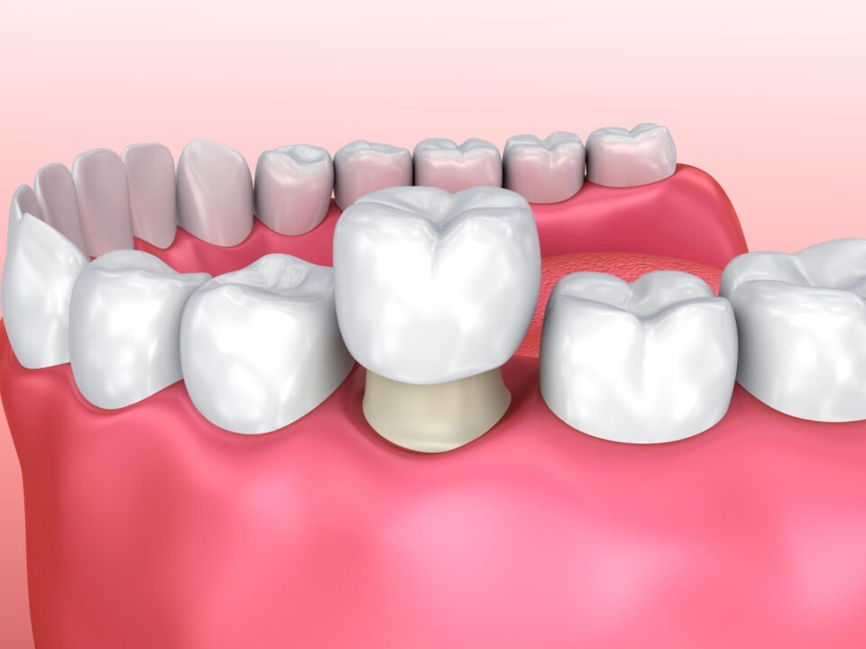 Lifestyle Factors That Extend the Lifespan of Dental Crowns