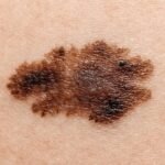The Importance of Dermatology in Skin Cancer Screening