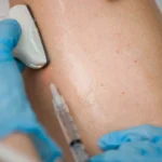 Understanding the Long-term Effects of Varicose Veins