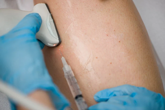 Understanding the Long-term Effects of Varicose Veins